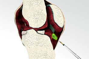 Radiosynviorthese